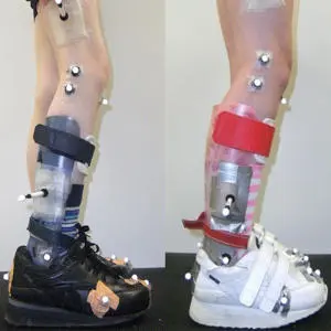 Two lower legs fitted with complex ankle-foot orthoses over black and white shoes.